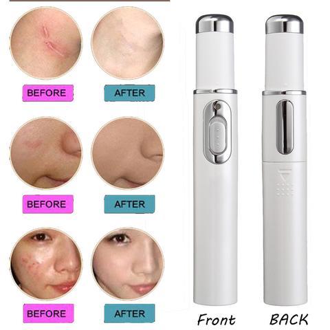 Blue Light Therapy Acne Laser Pen